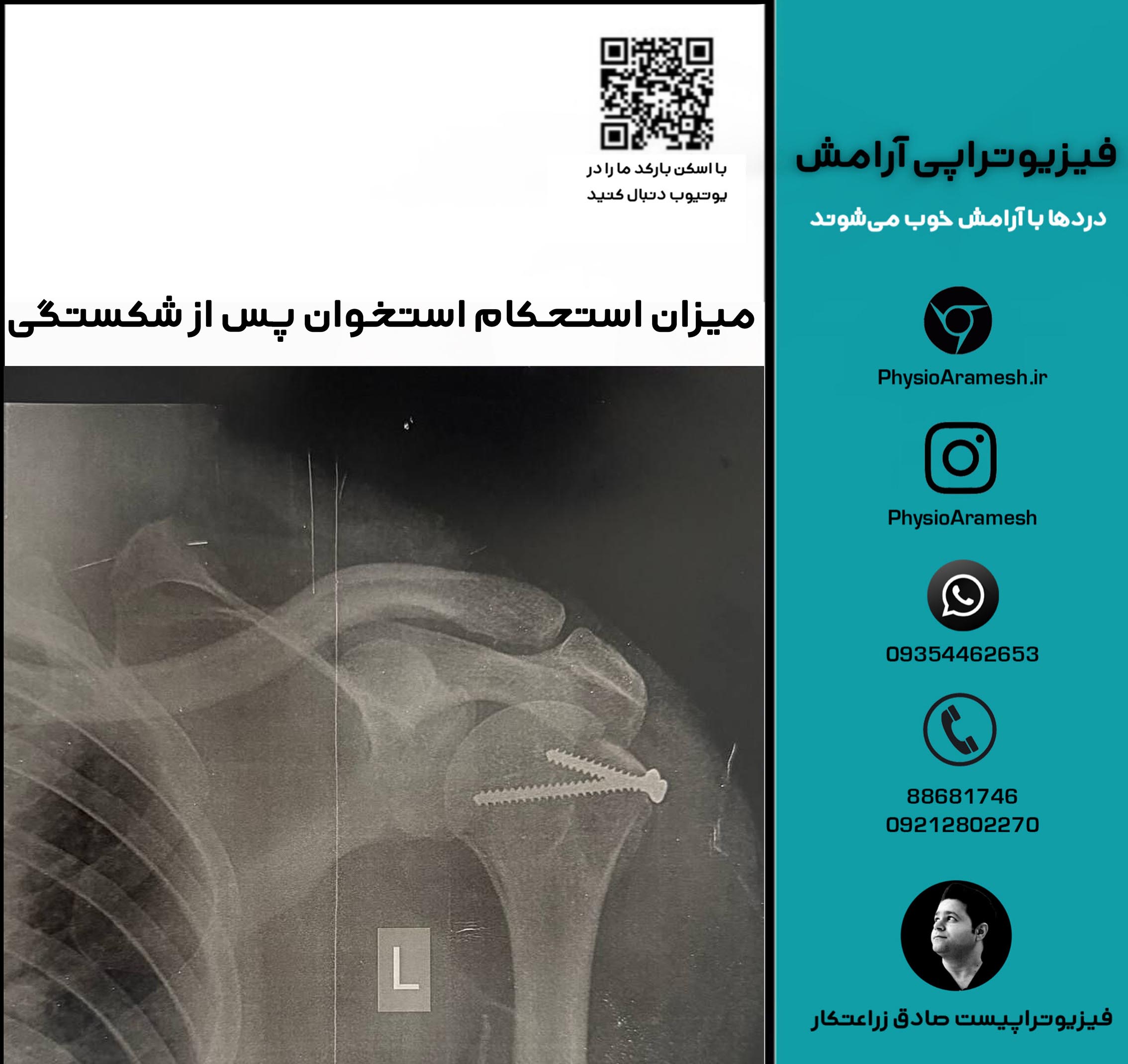 میزان استحکام استخوان پس از شکستگی